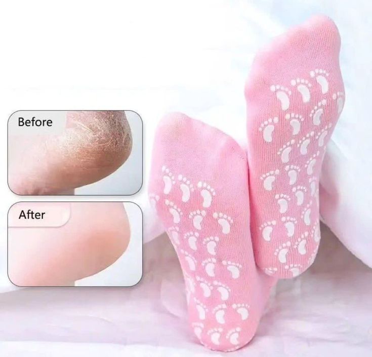 Exfoliating Foot Scrub Socks – Silicone Moisturizing Heel Repair Socks